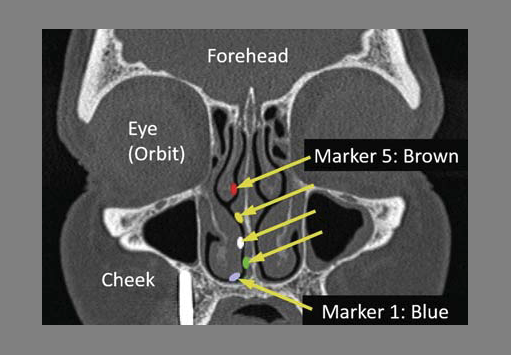 Frontal CT-view of the sinuses with marker positions